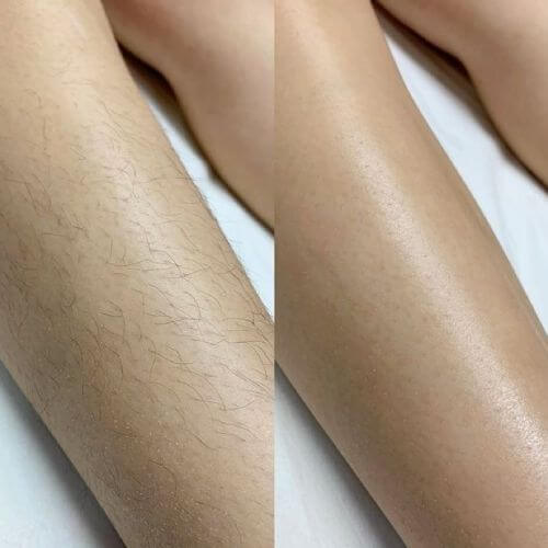 hizmetler serpil gün lazer epilasyon